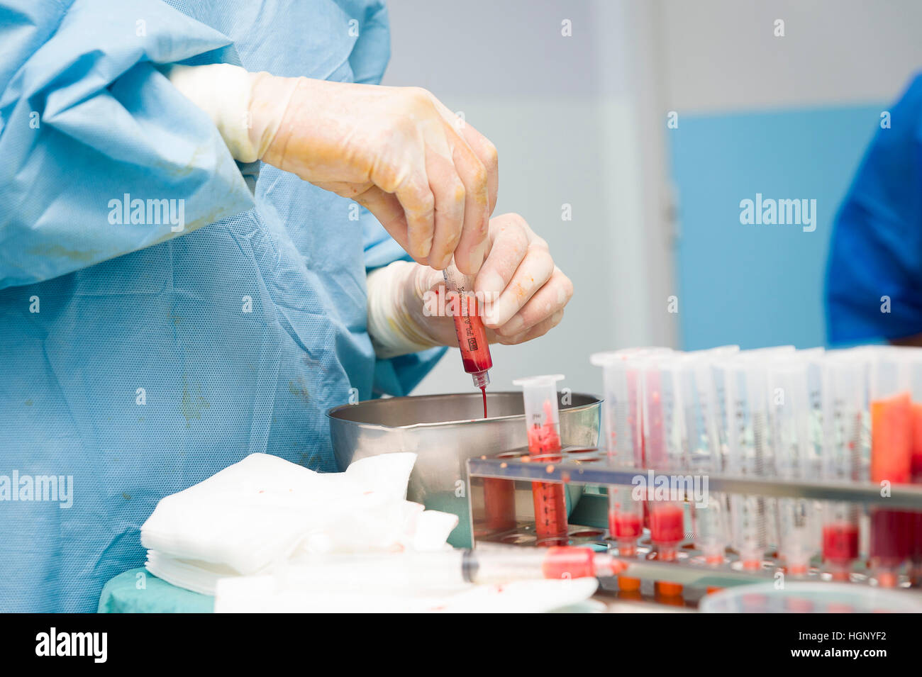 LIPOFILLING Stock Photo