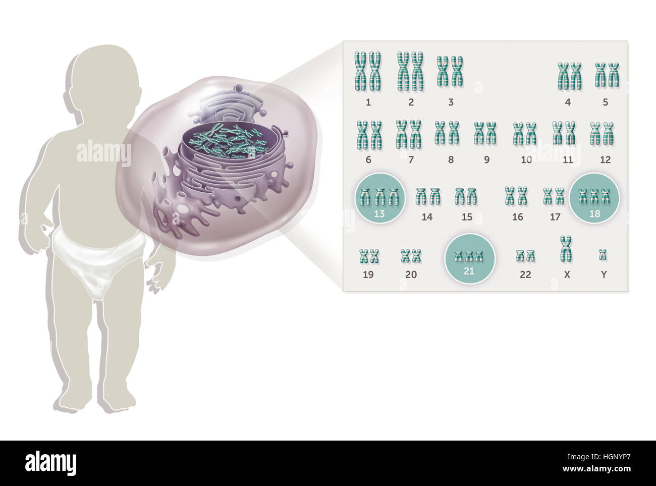 Trisomy 18 hires stock photography and images Alamy