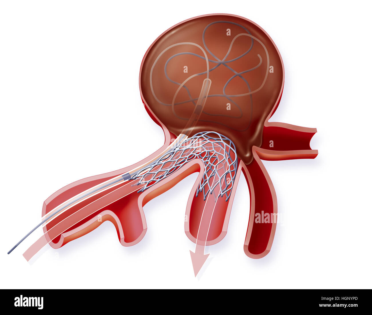 Burgundy ribbon symbol of brain aneurysm hi-res stock photography and  images - Alamy
