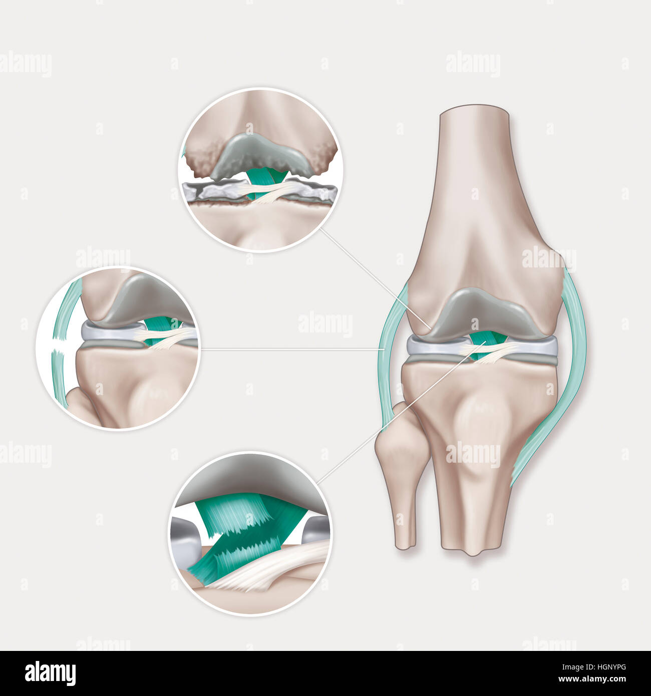 INJURY KNEE, ILLUSTRATION Stock Photo