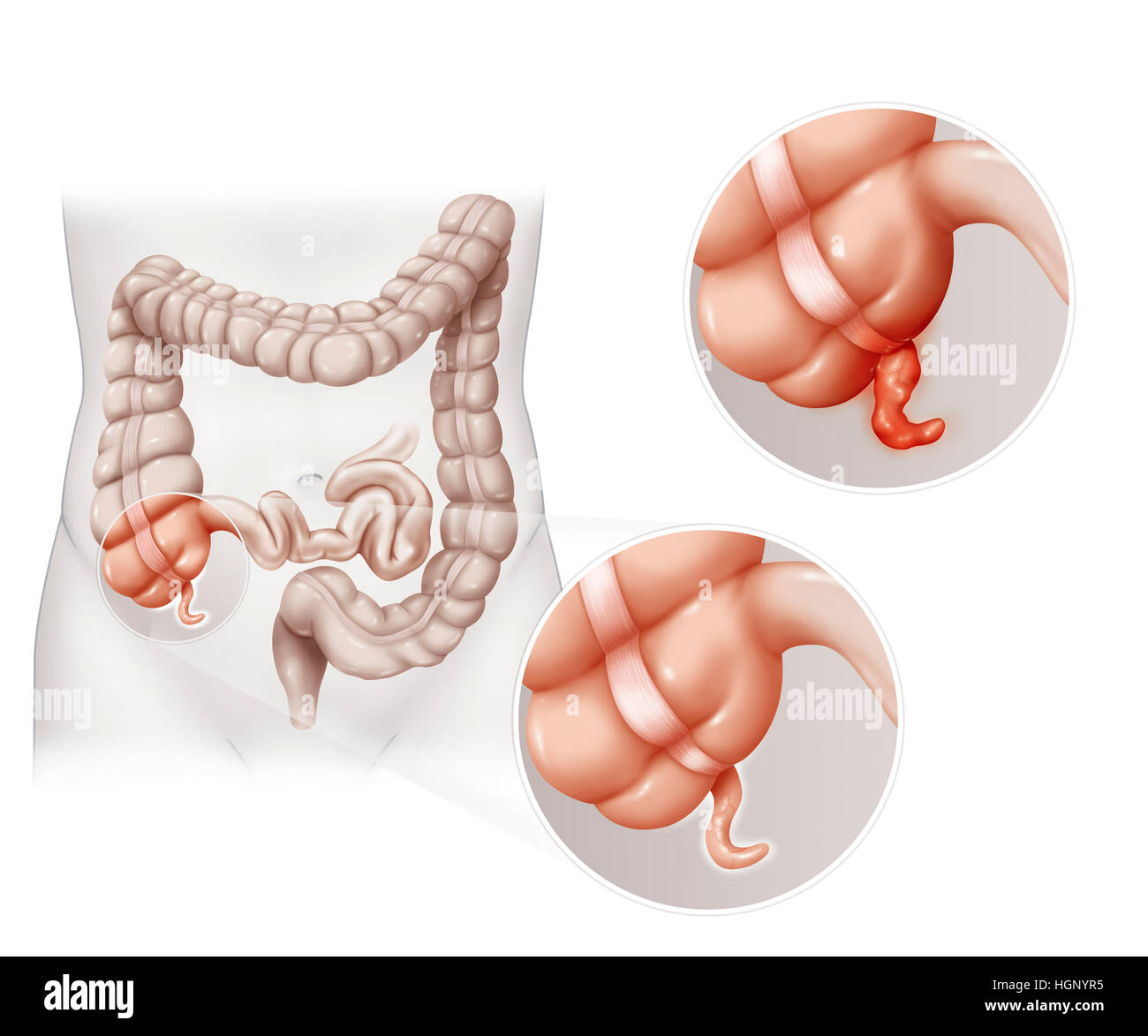 APPENDICITIS, DRAWING Stock Photo