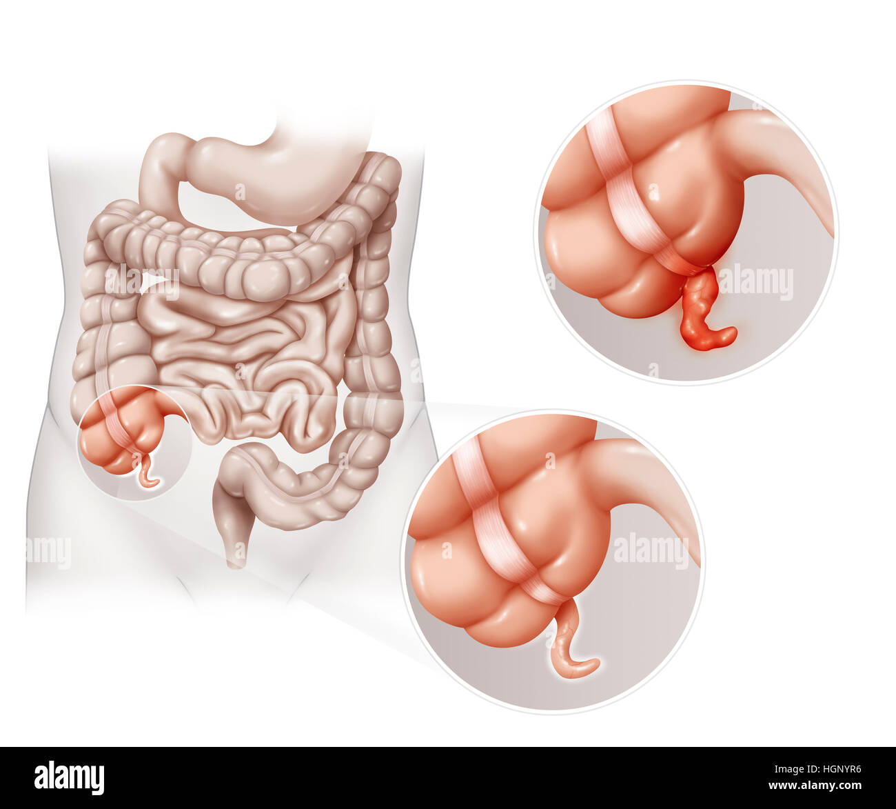 APPENDICITIS, DRAWING Stock Photo