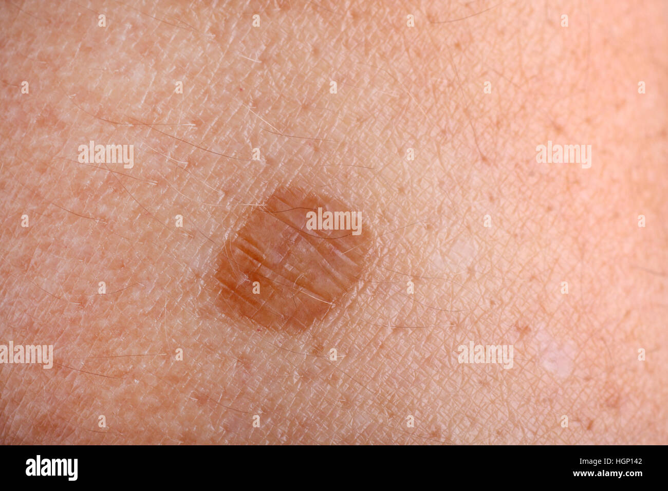 Age Spots (Solar Lentigo, Liver Spots) - Harvard Health