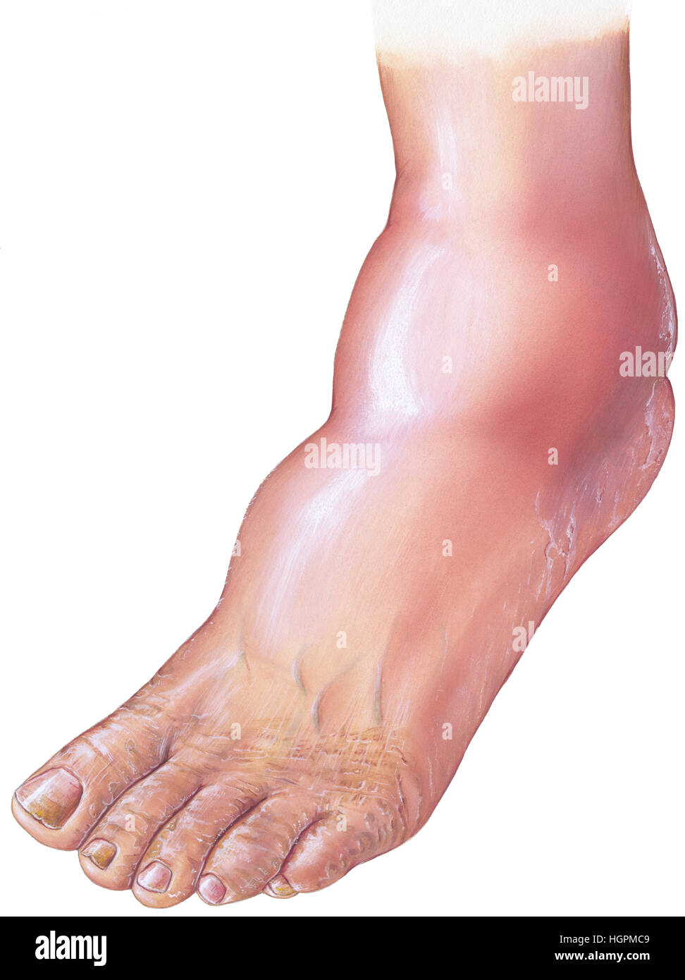 Diabetic arterial disease and foot drop. Foot drop is associated with vascular disorders (especially in diabetics), and symptoms may result from ankle Stock Photo