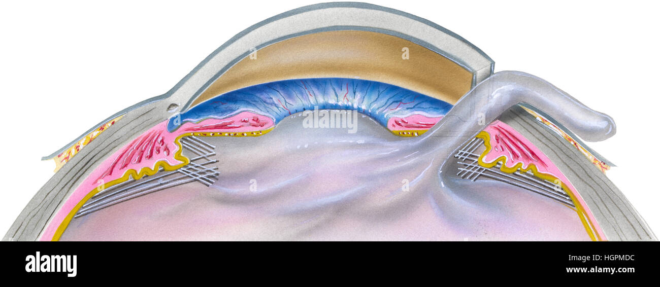 Step 2 of 7 A cataract is an eye disease in which the normally clear