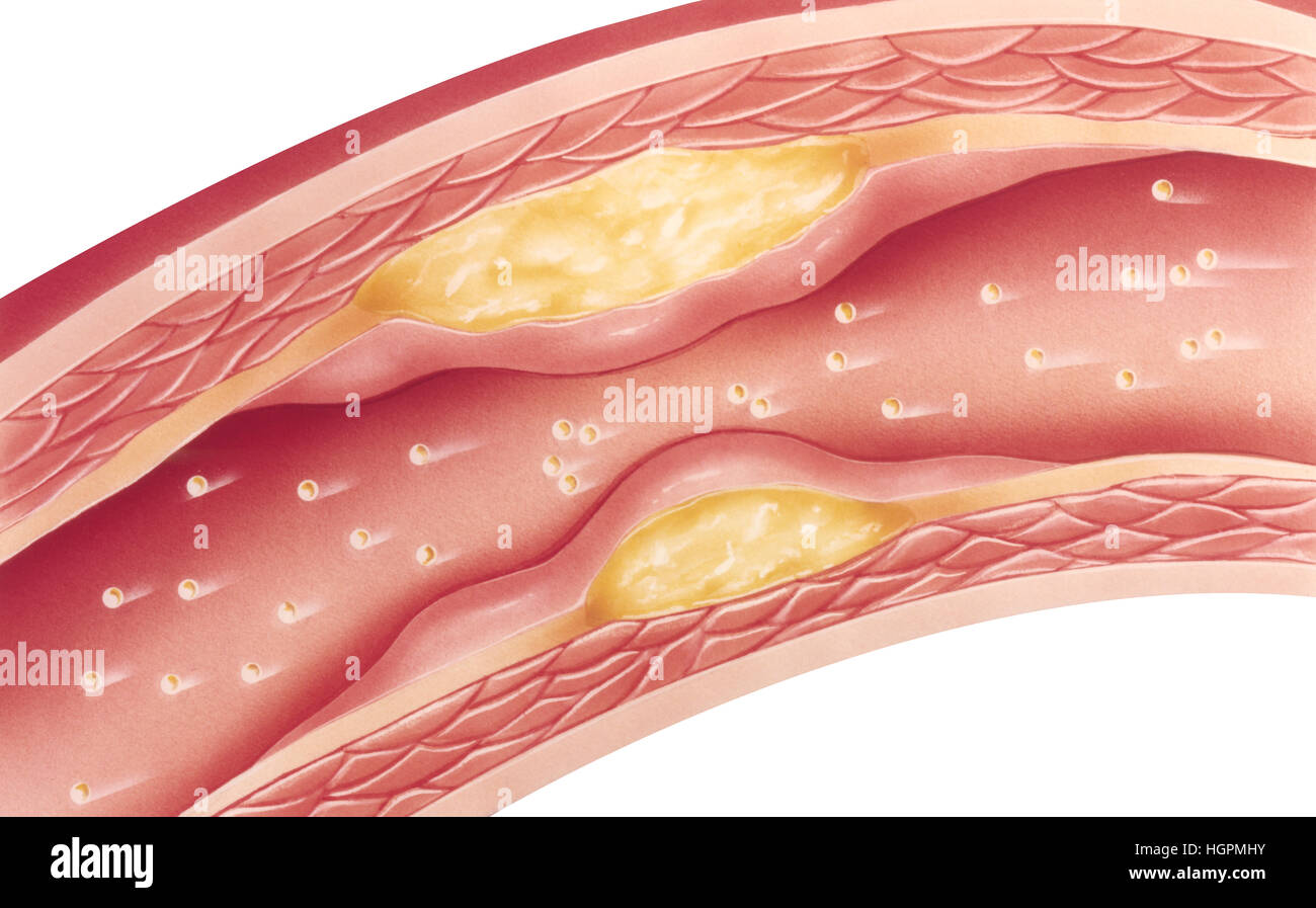 Vascular atherosclerosis showing a cutaway view of accumulated plaque