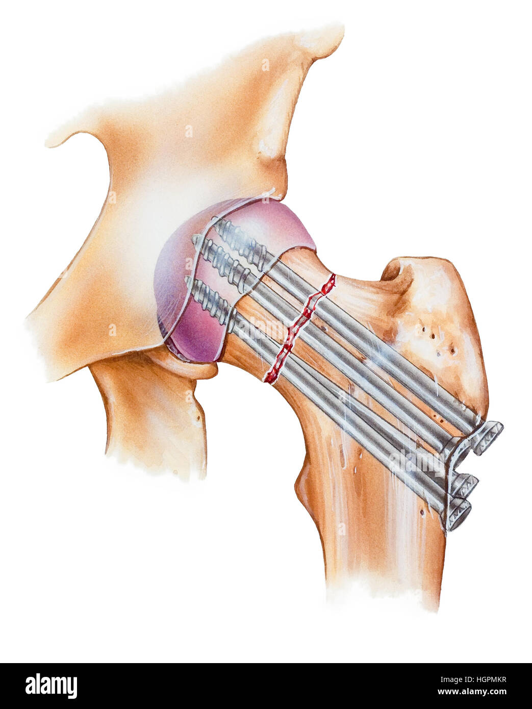 Illustration of a hip fracture repair. Shown is a fracture of the