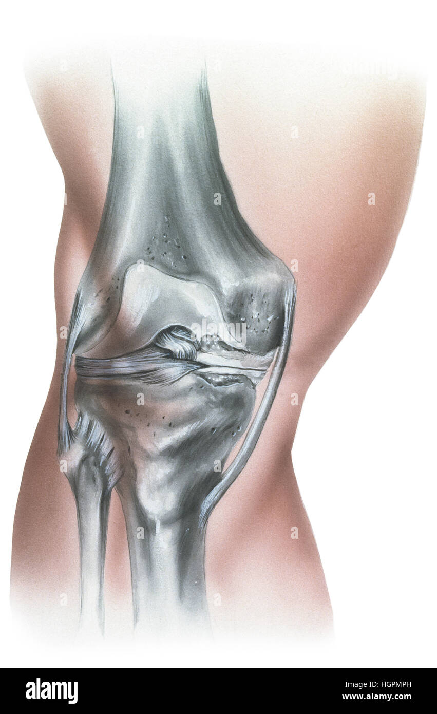Shown is a knee with erosion of the cartilage causing meniscus damage. There is also hypertrphyof the knee bone and lining. Stock Photo