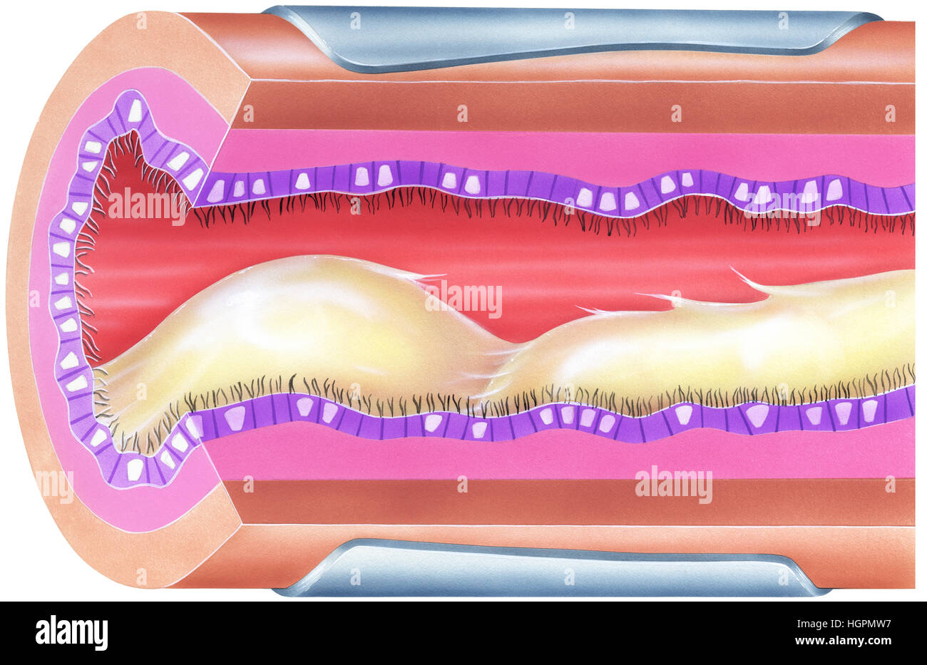 Shown is bronchial airway obstruction and narrowing due to viscid mucus. Excessive mucus in bronchial airways can cause significant obstruction and an Stock Photo