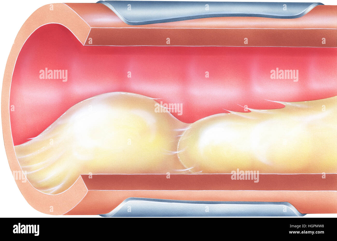 Lungs - Bronchial Mucus. Shown is bronchial airway obstruction and narrowing due to viscid mucus. Stock Photo