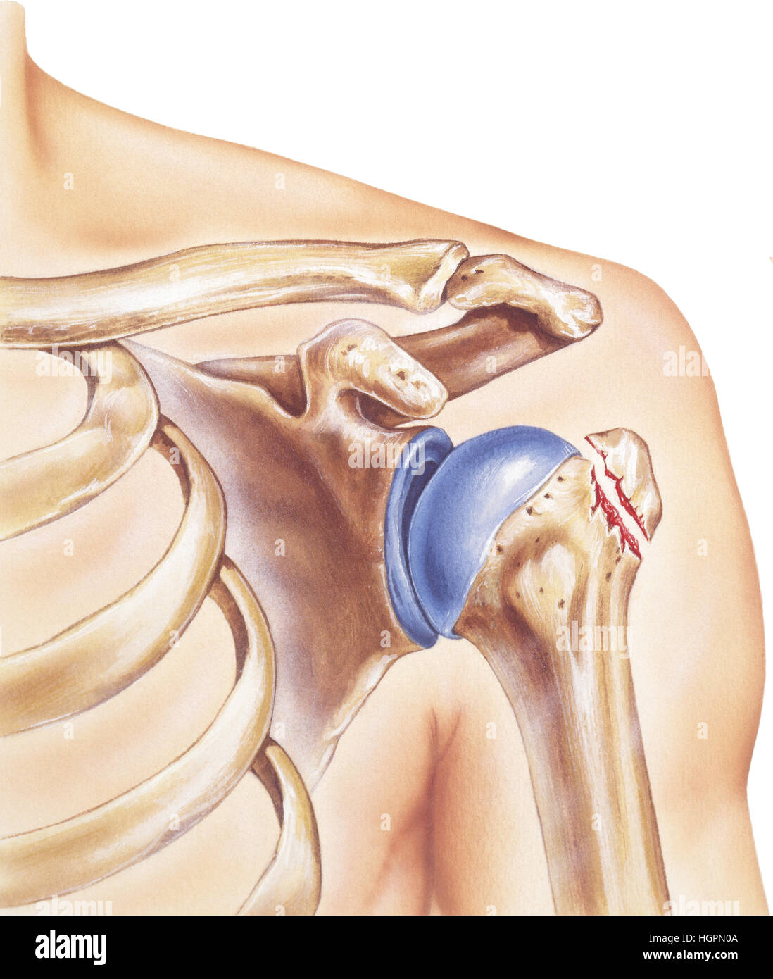 Shoulder - Broken Greater Tubercle. Anatomy of the bones and joints of a shoulder with a broken greater tubercle. Stock Photo