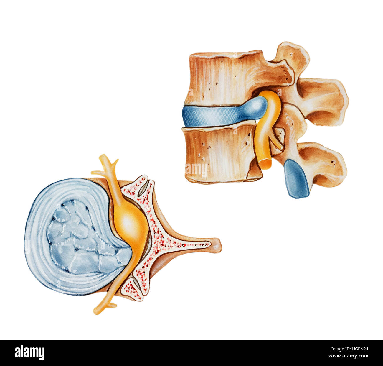 A herniated (slipped or ruptured) disc, side (top) and top (left) views