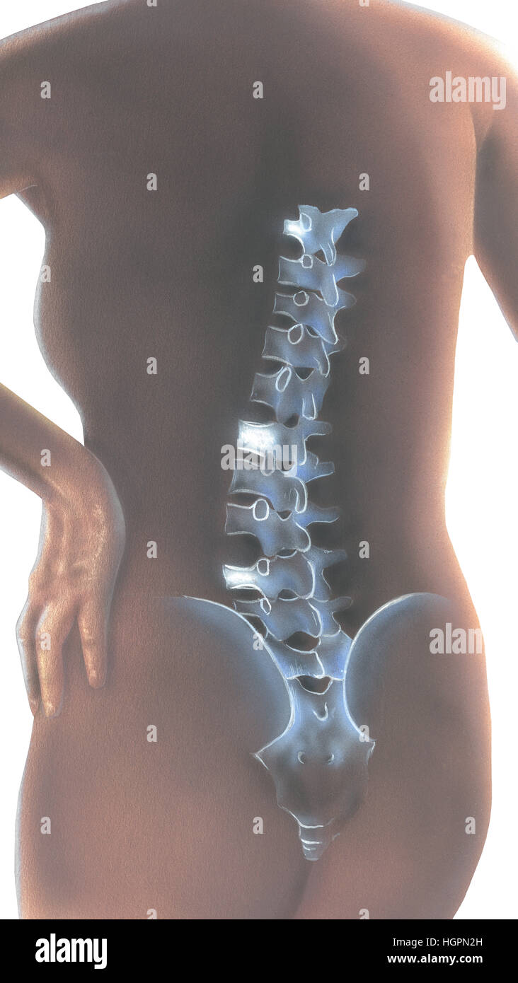 Spine - Back Pain. Posterior view of a woman's back showing pain in the lumbar and thoracic vertebrae. Stock Photo