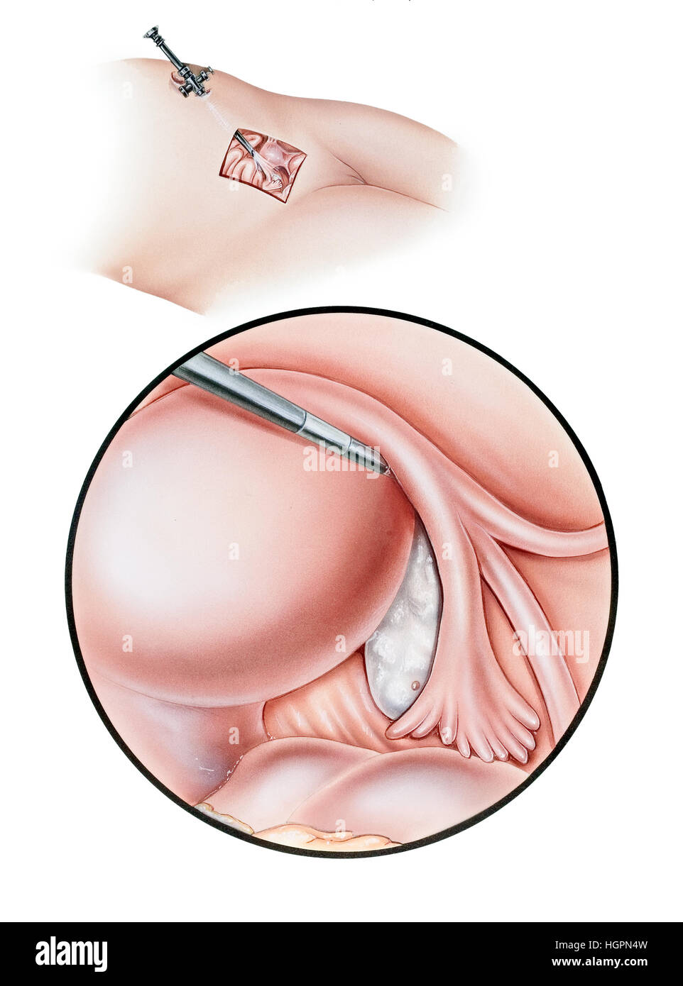 Surgery - Diagnostic Laparoscopy. Shown are broad cutaway (top) and close up (bottom) views that depict the laparoscope, fallopian tube, fibria, ovary Stock Photo