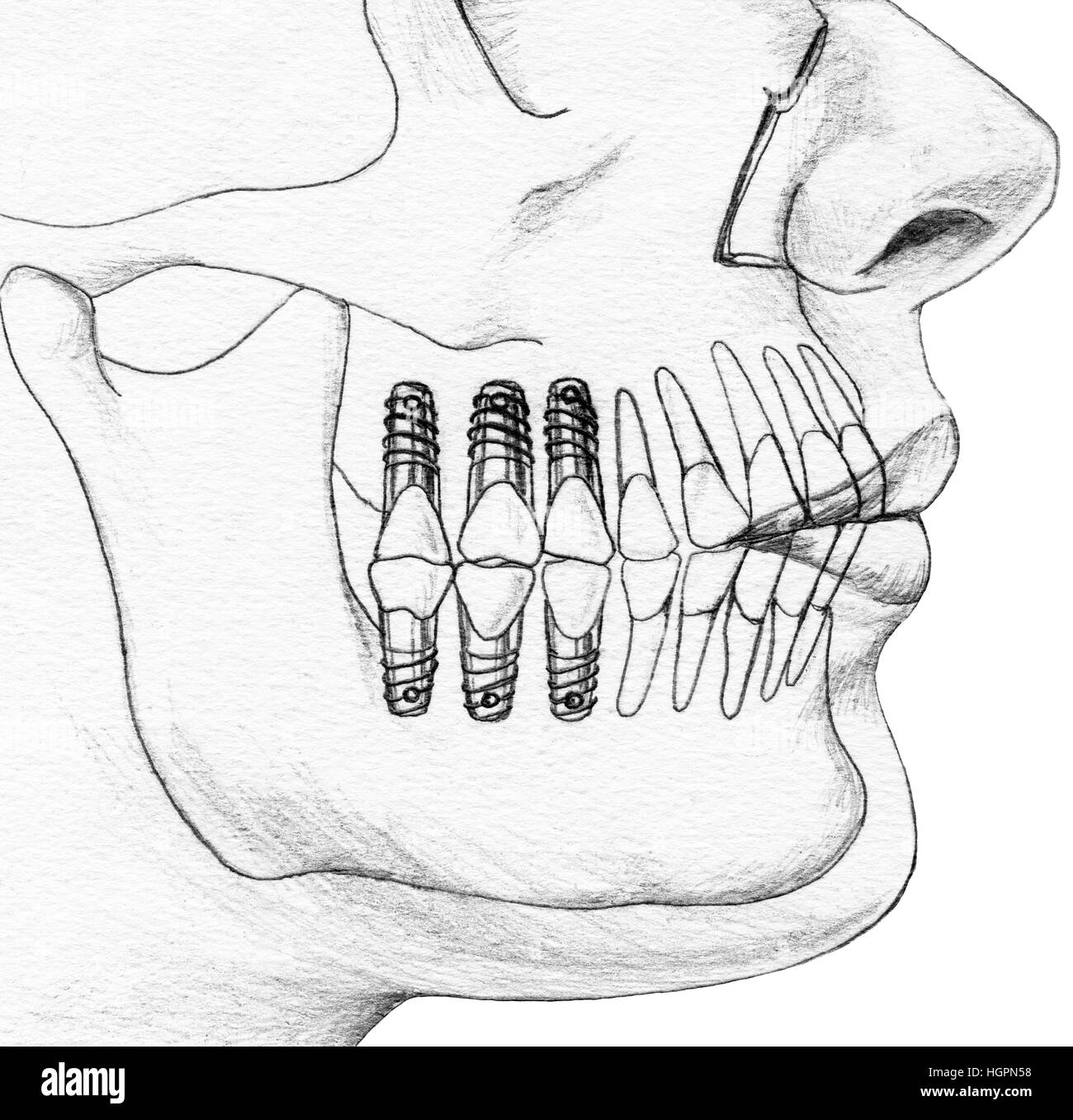 Teeth - Dental Implants In context, cutaway view Stock Photo