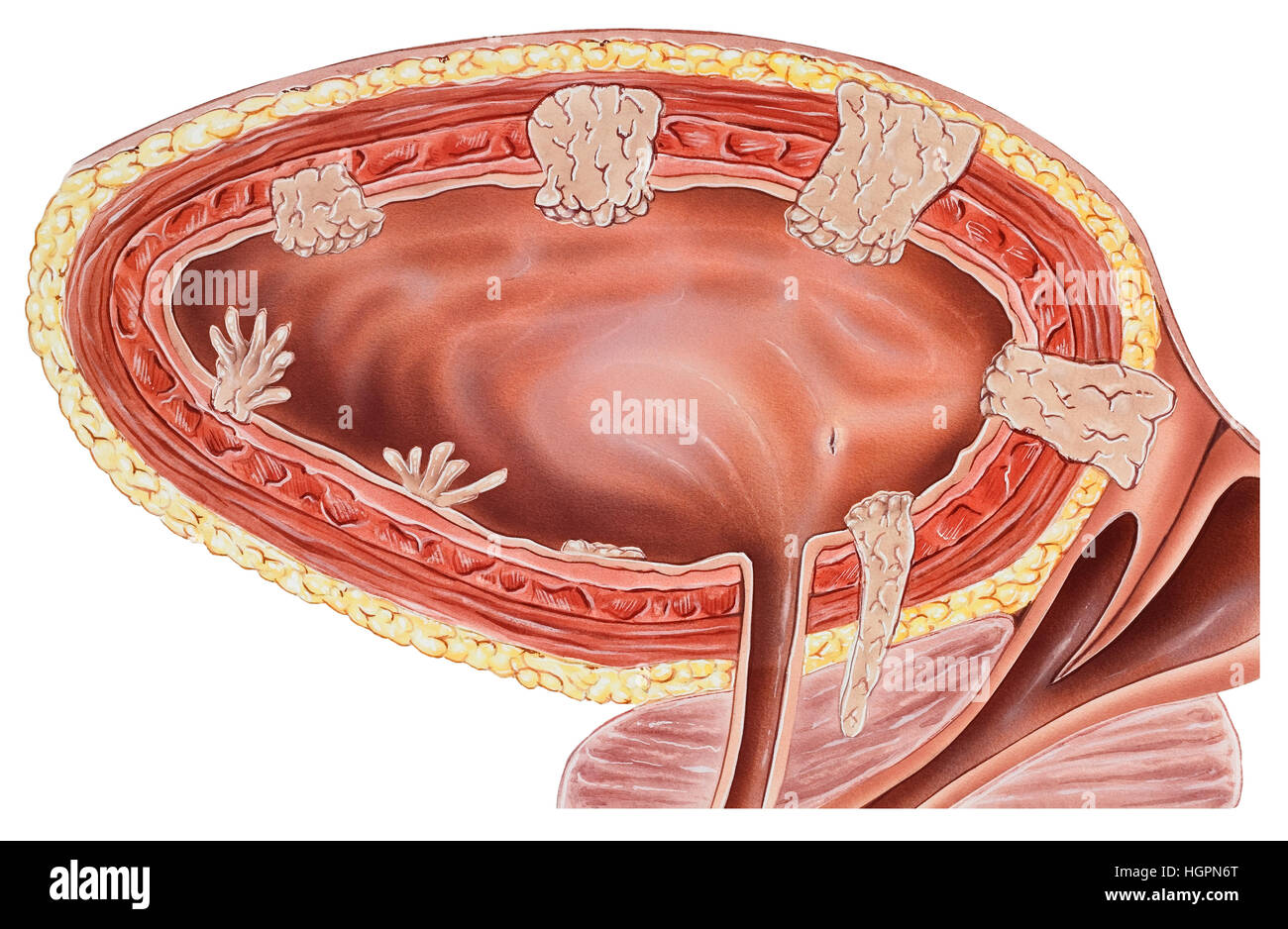 ранний рак мочевого пузыря симптомы. раковая опухоль мочевого пузыря. опухоль мочевого пузыря. опухоль мочевого пузыря у мужчин стадии. алгоритм диагностики опухолей мочевого пузыря.
