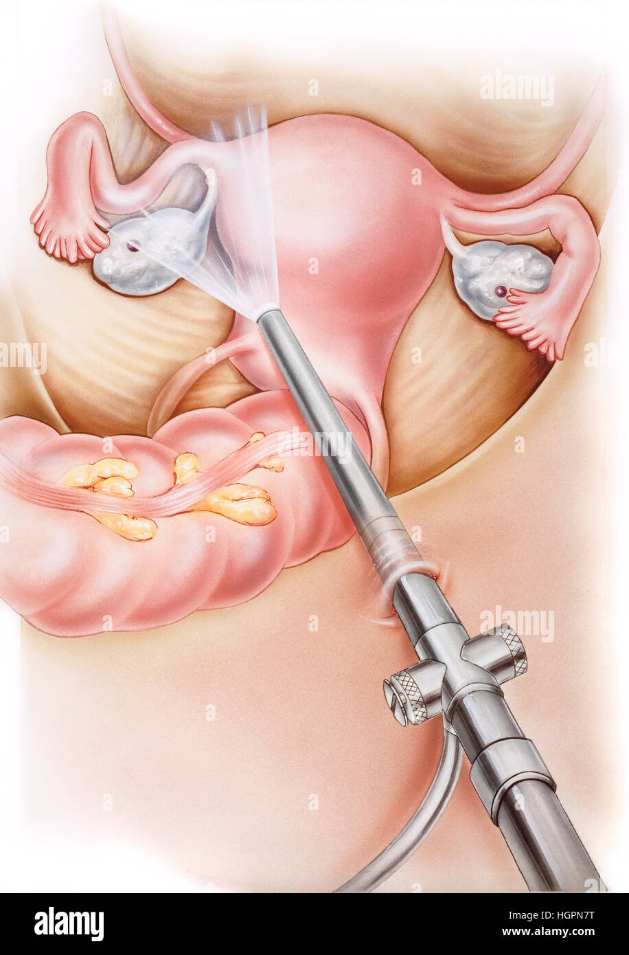 Uterus - Laparoscopy, in which a small incision is made in the abdomen and the laparoscope is inserted to view internal female organs. The ovaries, fa Stock Photo