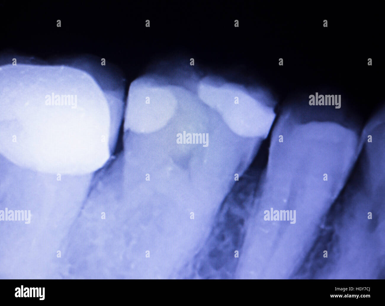 Tooth with filling dental xray closeup image showing teeth roots, gum