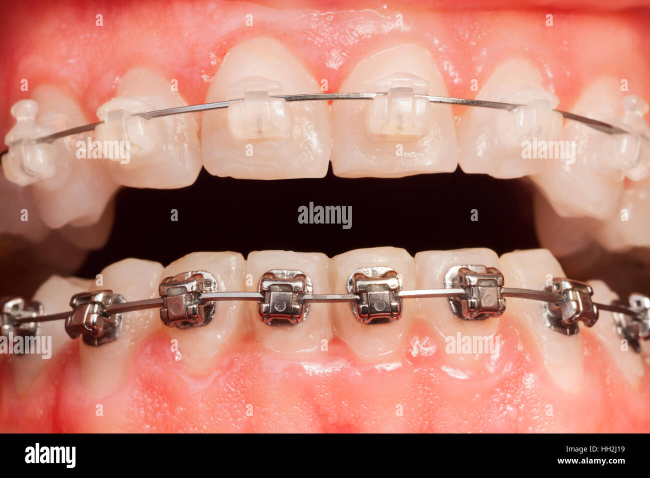 Metal braces hi-res stock photography and images - Alamy