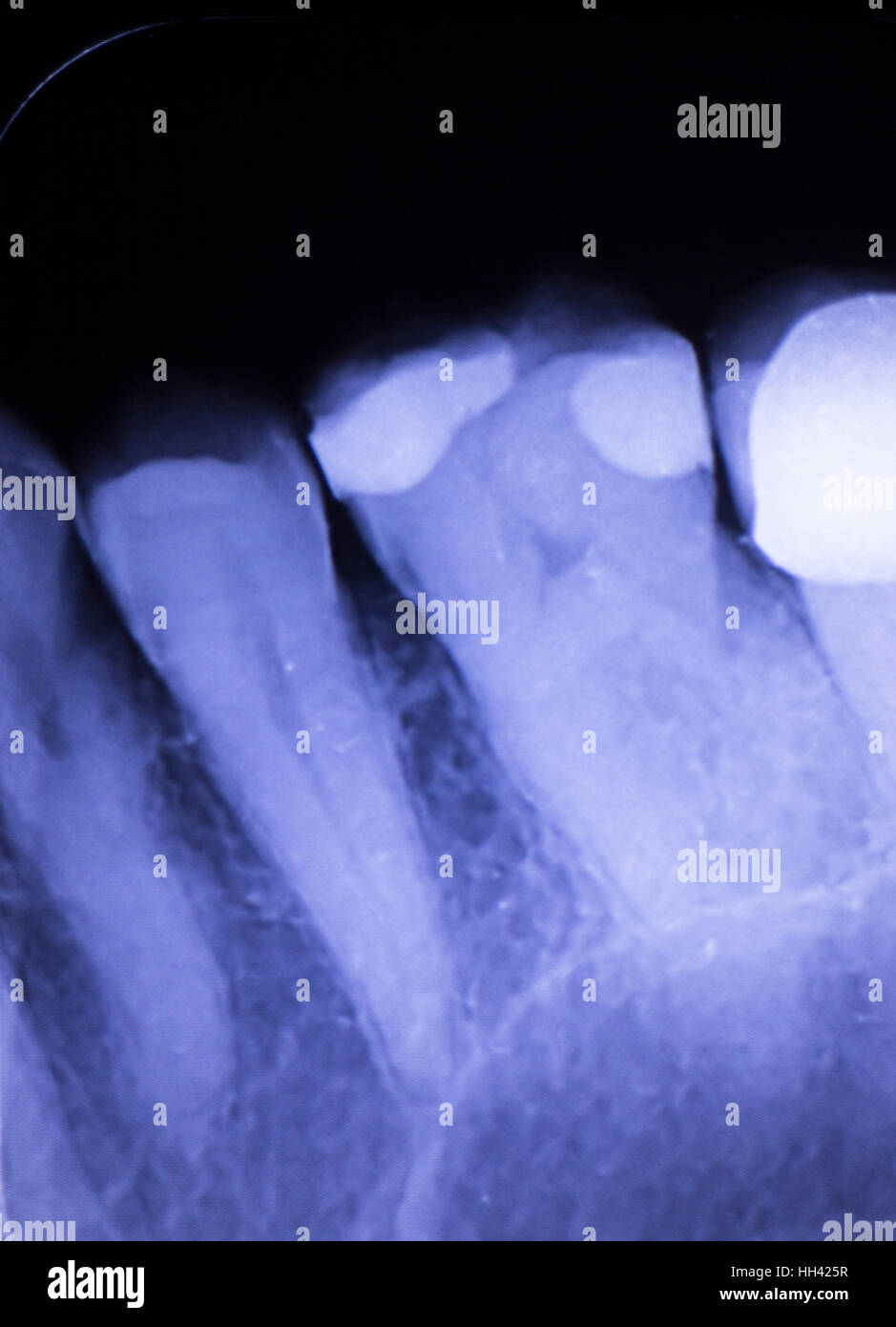 Tooth with filling dental xray closeup image showing teeth roots, gum