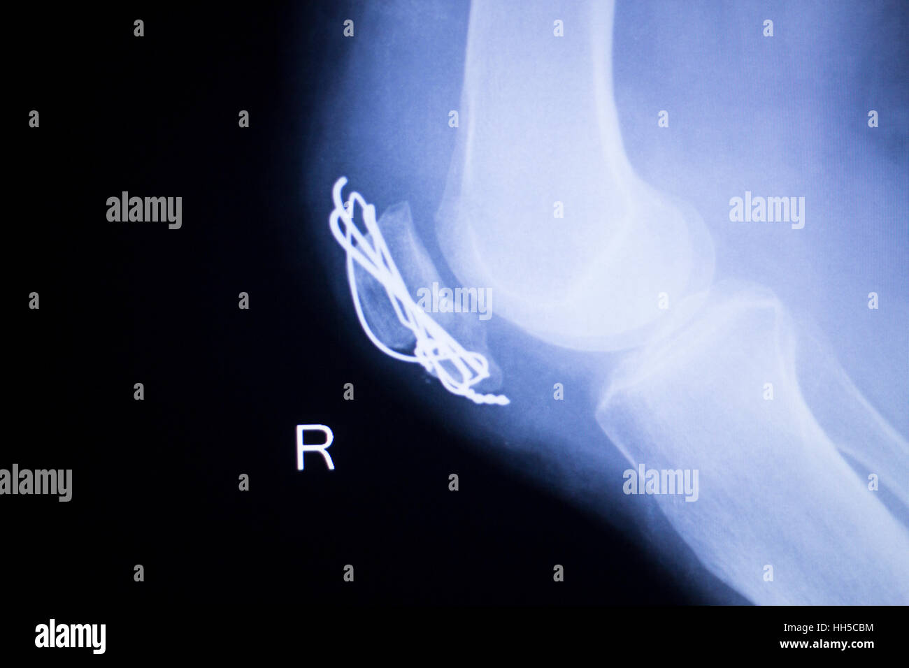 Knee joint implant screw xray showing in medical orthpodedic