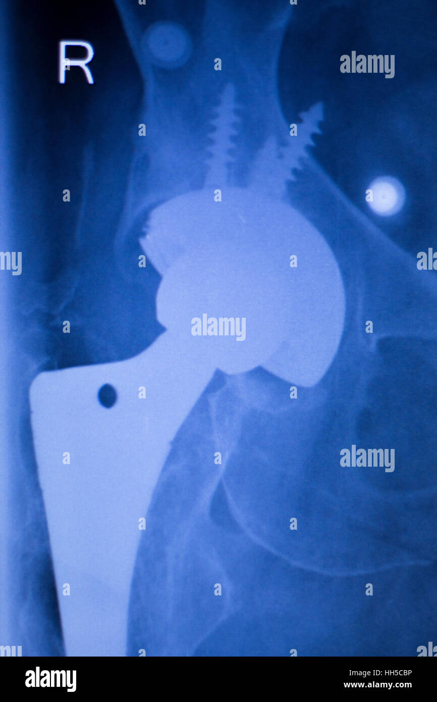 Hip ball and socket hires stock photography and images Alamy