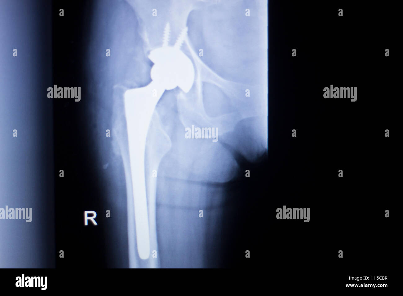 Ball And Socket Joint Stock Photos & Ball And Socket Joint Stock Images