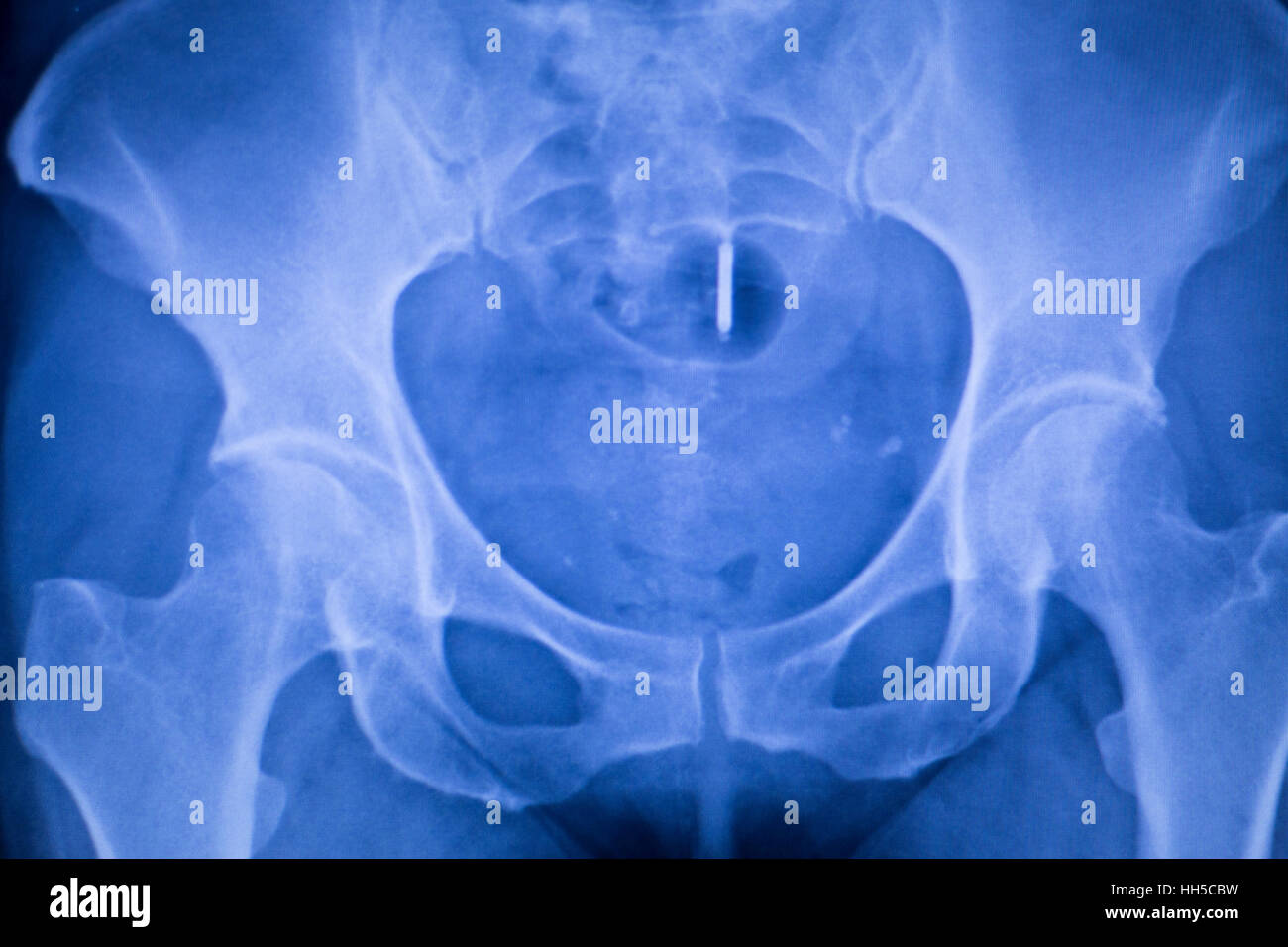 Hip Socket Stock Photos & Hip Socket Stock Images Alamy