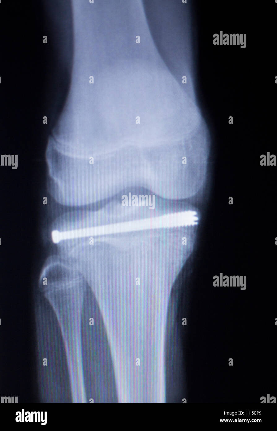 Knee joint implant screw xray showing in medical orthpodedic