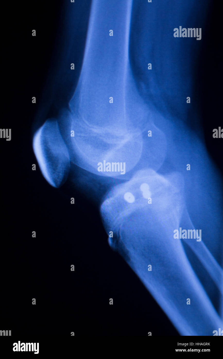 Knee joint implant screw xray showing in medical orthpodedic