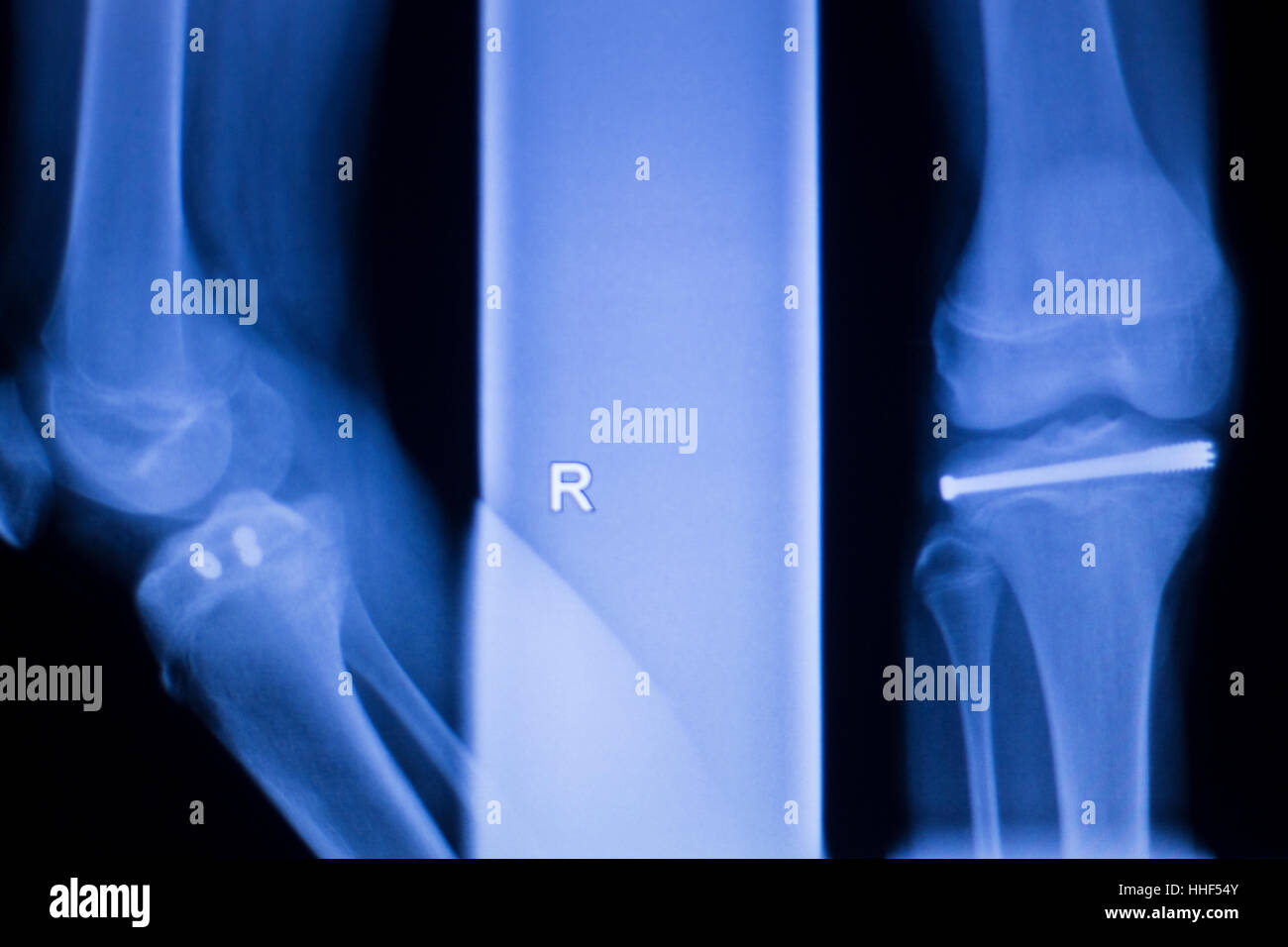 Knee joint implant screw xray showing in medical orthpodedic