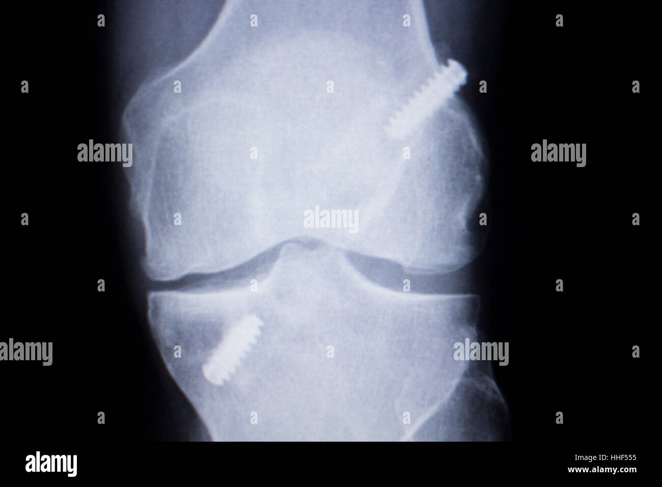 Knee joint implant screw xray showing in medical orthpodedic ...