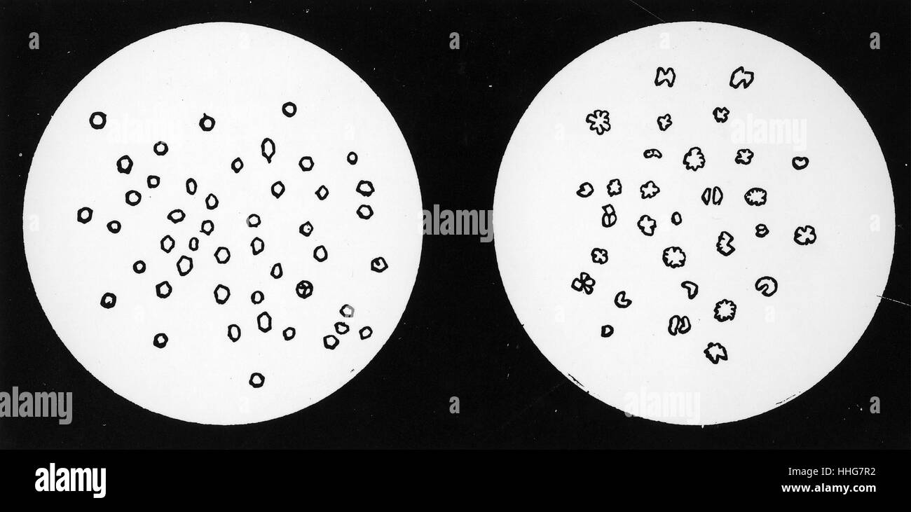 Microscopic views: Left: Normal granules in the blood of a silkworm. Right: Appearance of granules in blood of silkworm infected with Grasserie. 1921. Stock Photo