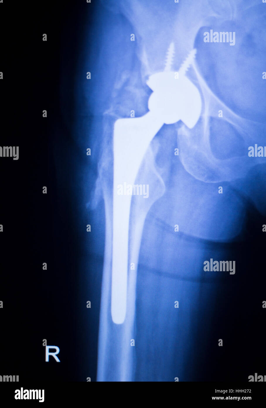 Shoulder Orthopedics Implant Xray Stock Photo C Edwardolive 118152216