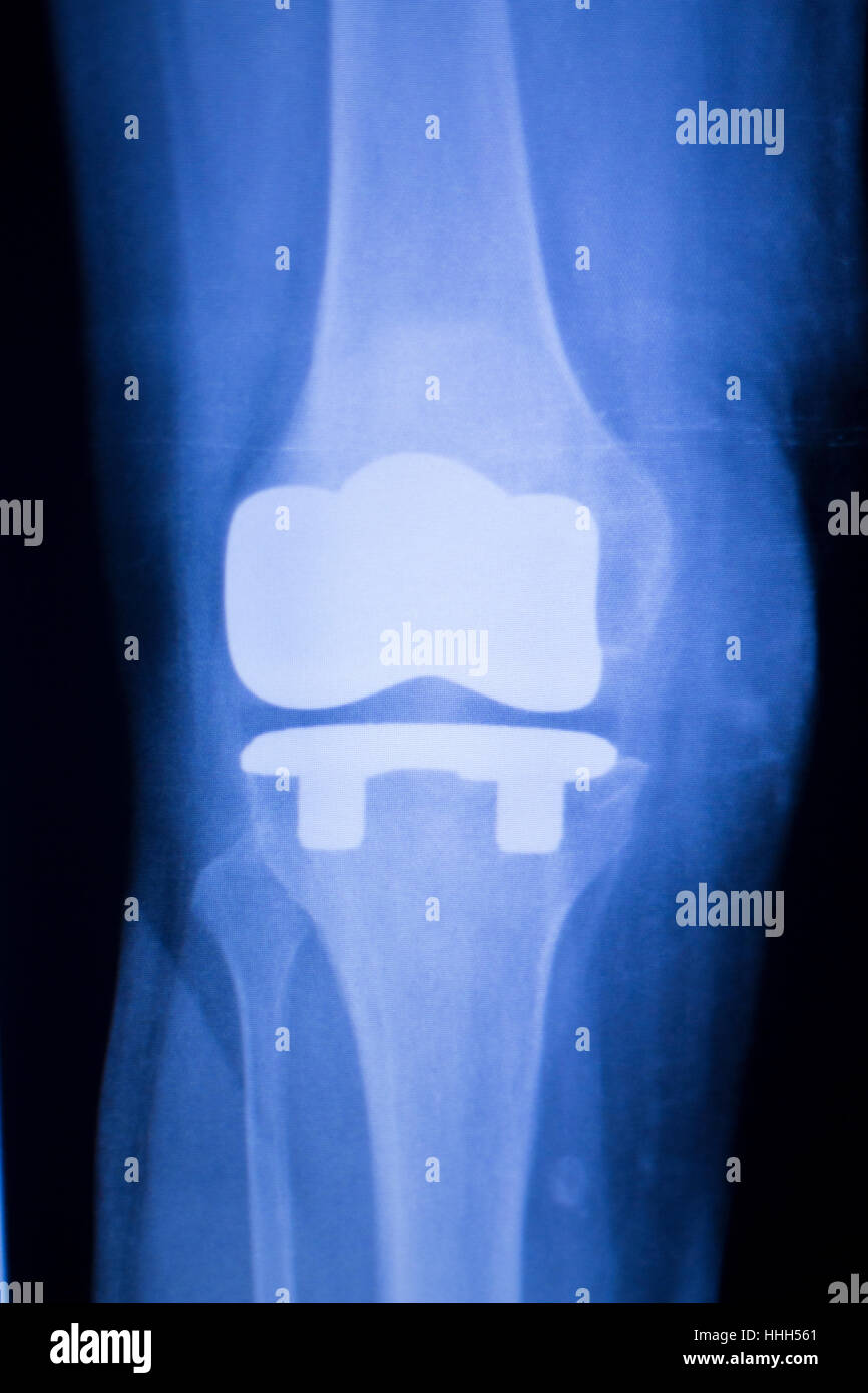 Knee joint implant replacement xray showing in medical orthpodedic