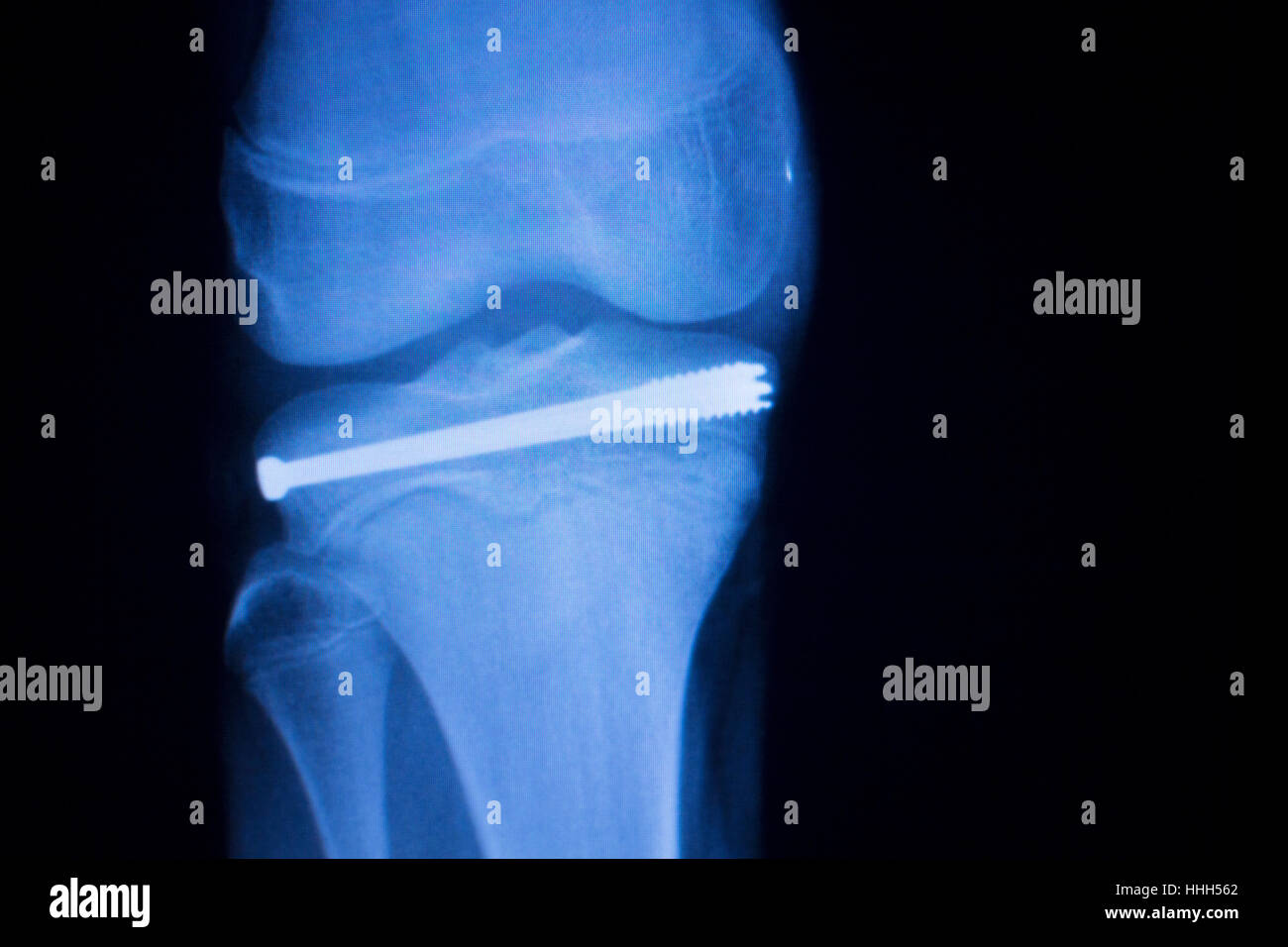 Knee joint implant screw xray showing in medical orthpodedic