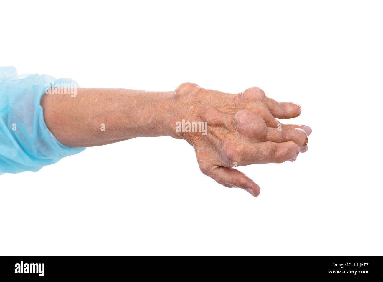 A man with a diagnosis of polyarthritis (severe stage) . The local clinic diagnosed inability to treat the disease at this stage. Russia. Stock Photo