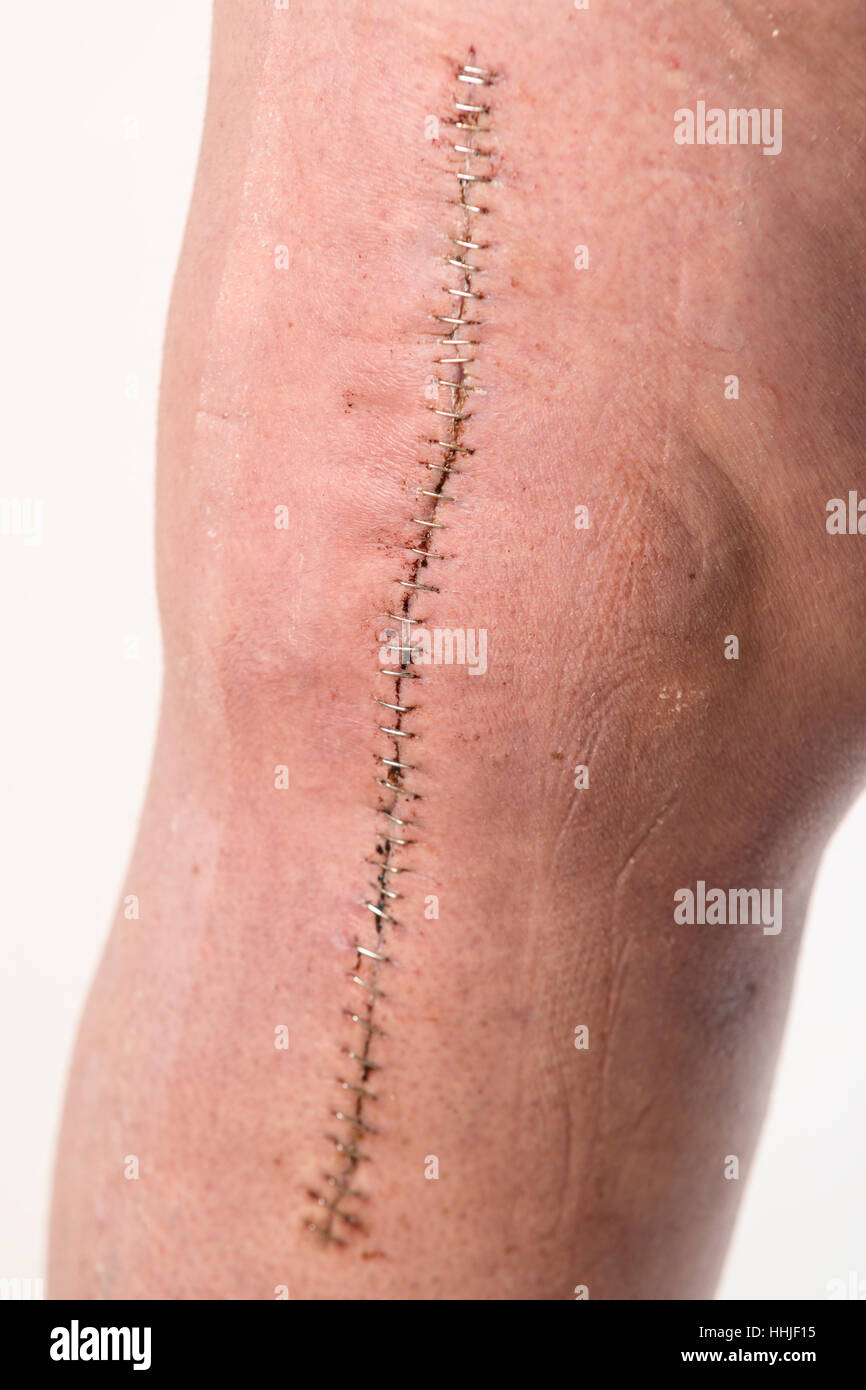 Close up of large post knee surgery incision held together with staples  Model Release: Yes.  Property Release: No. Stock Photo