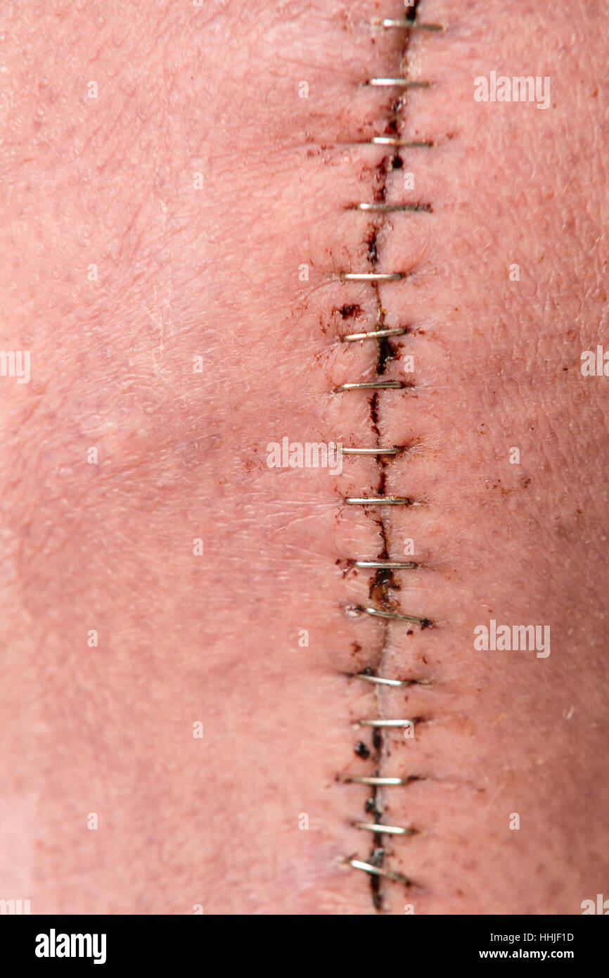 Close up of large post knee surgery incision held together with staples  Model Release: Yes.  Property Release: No. Stock Photo