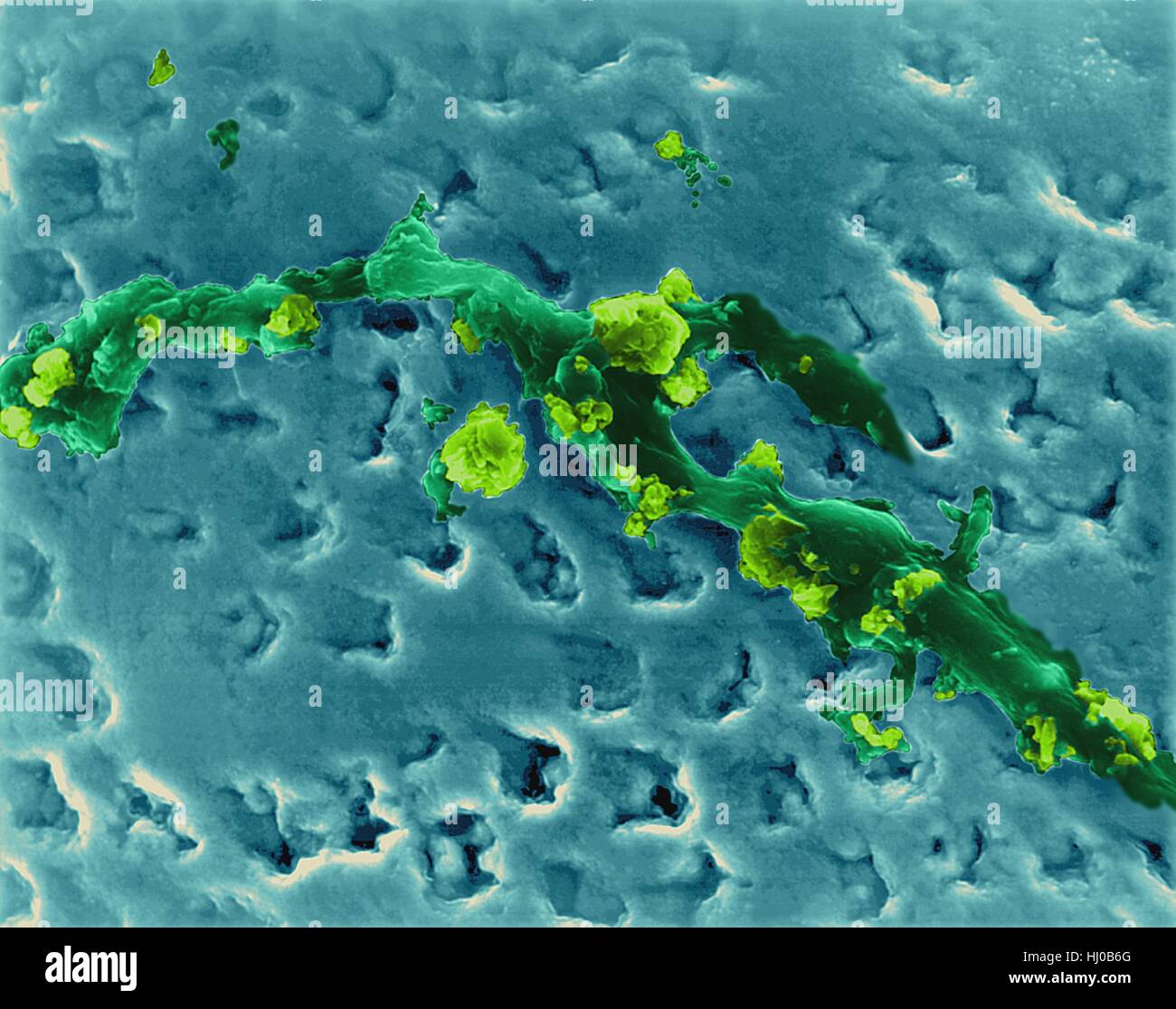 Human tooth accumulation of bacterial plaque (smooth areas) calcified