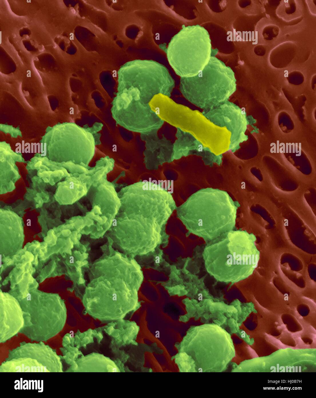 Bacteria on an epithelial cell from the human tongue filiform papilla, coloured scanning electron micrograph (SEM). Coccoid bacteria (likely Streptococcus mutans due to the fibrous glucan matrix that surrounds the cells) and one rod bacterium are seen on the epithelial surface. Most bacteria on the human tongue are harmless or even beneficial. However some bacteria can cause throat infections and form plaque deposits on teeth. Plaque will also lead to tooth decay and periodontal disease. Magnification: x5, 000 when shortest axis printed at 25 millimetres. Stock Photo