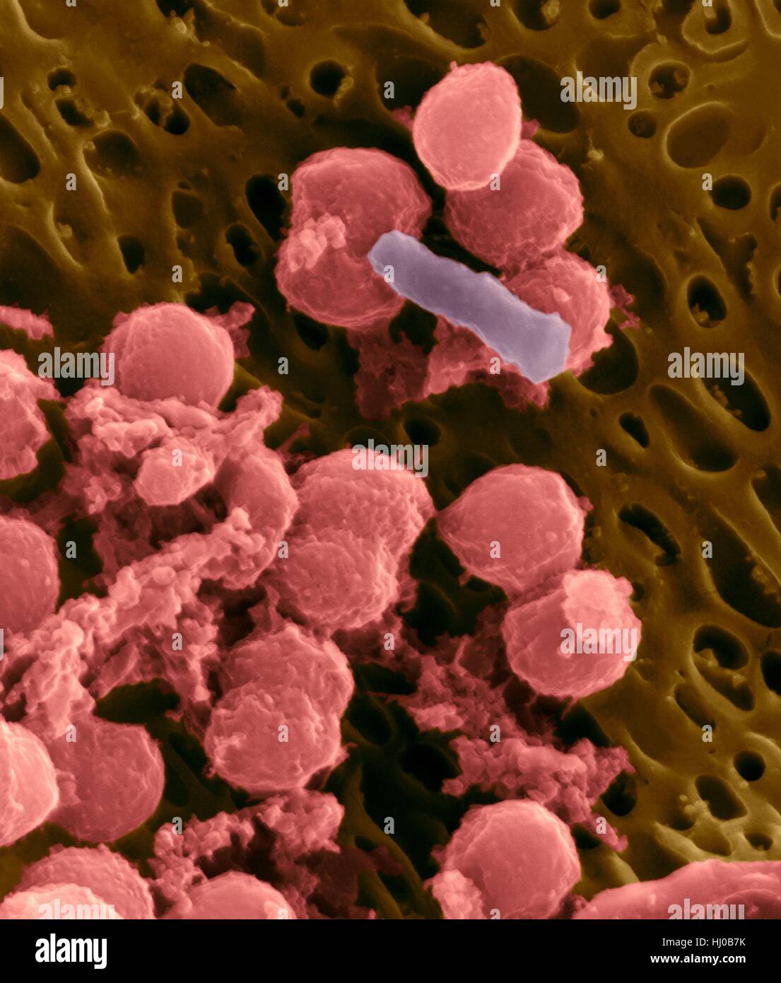 Bacteria on an epithelial cell from the human tongue filiform papilla, coloured scanning electron micrograph (SEM). Coccoid bacteria (likely Streptococcus mutans due to the fibrous glucan matrix that surrounds the cells) and one rod bacterium are seen on the epithelial surface. Most bacteria on the human tongue are harmless or even beneficial. However some bacteria can cause throat infections and form plaque deposits on teeth. Plaque will also lead to tooth decay and periodontal disease. Magnification: x5, 000 when shortest axis printed at 25 millimetres. Stock Photo