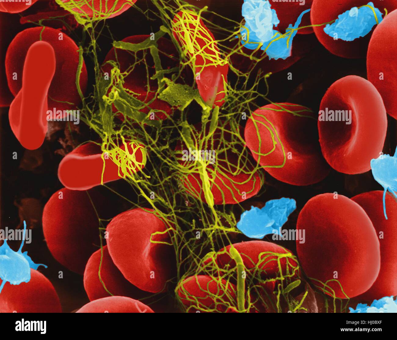 Human red blood cells trapped in fibrin blood clot,composite coloured scanning electron micrograph (SEM).Platelets in blood are small oval disks are termed nonactivated platelets or thrombocytes.Platelets serve as body's first line of defence to prevent excessive blood loss.When injury such as cut Stock Photo
