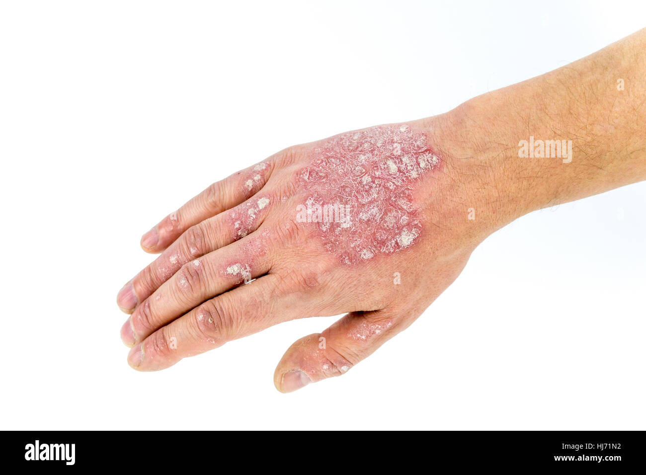 psoriasis on the hand isolated on white background Stock Photo