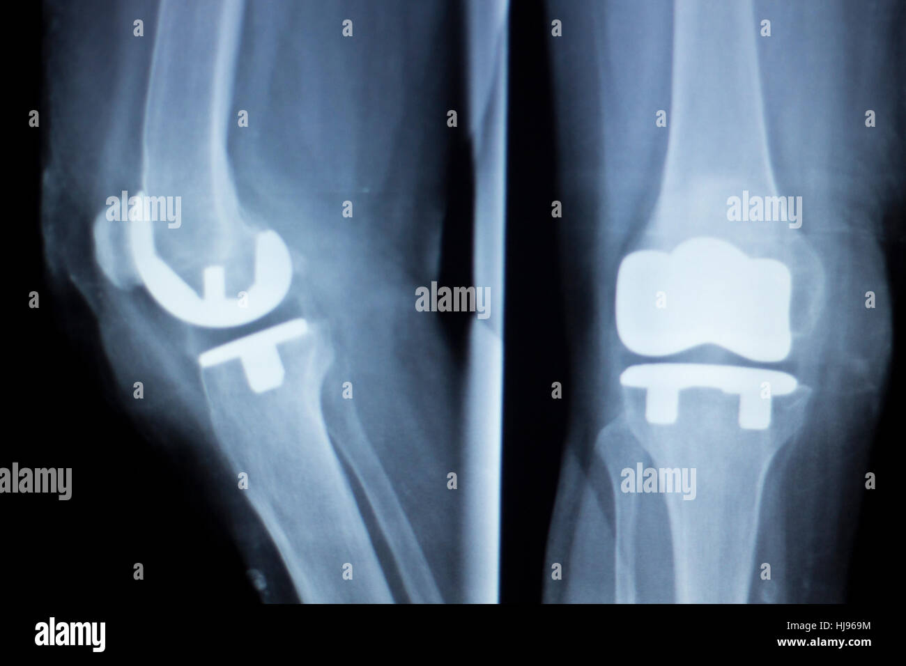 Knee joint implant replacement xray showing in medical orthpodedic traumatology scan. Stock Photo