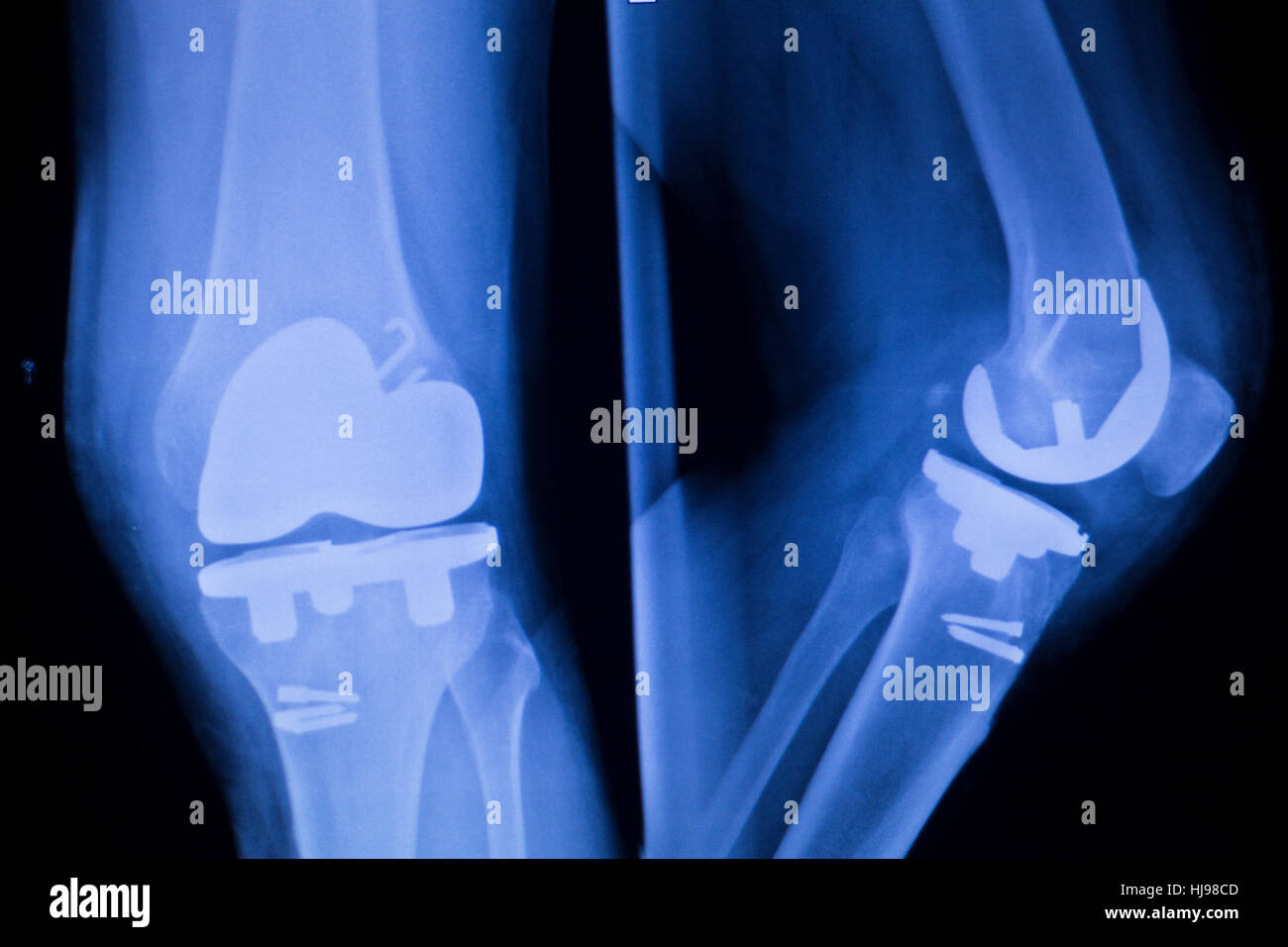 Knee joint implant replacement xray showing in medical orthpodedic traumatology scan. Stock Photo