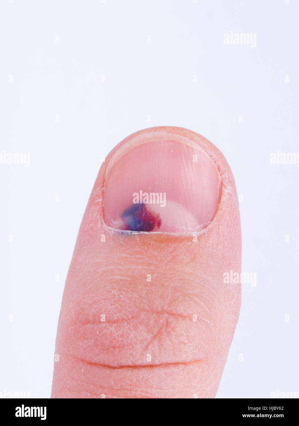 Subungual hematoma collection of blood underneath fingernail (black