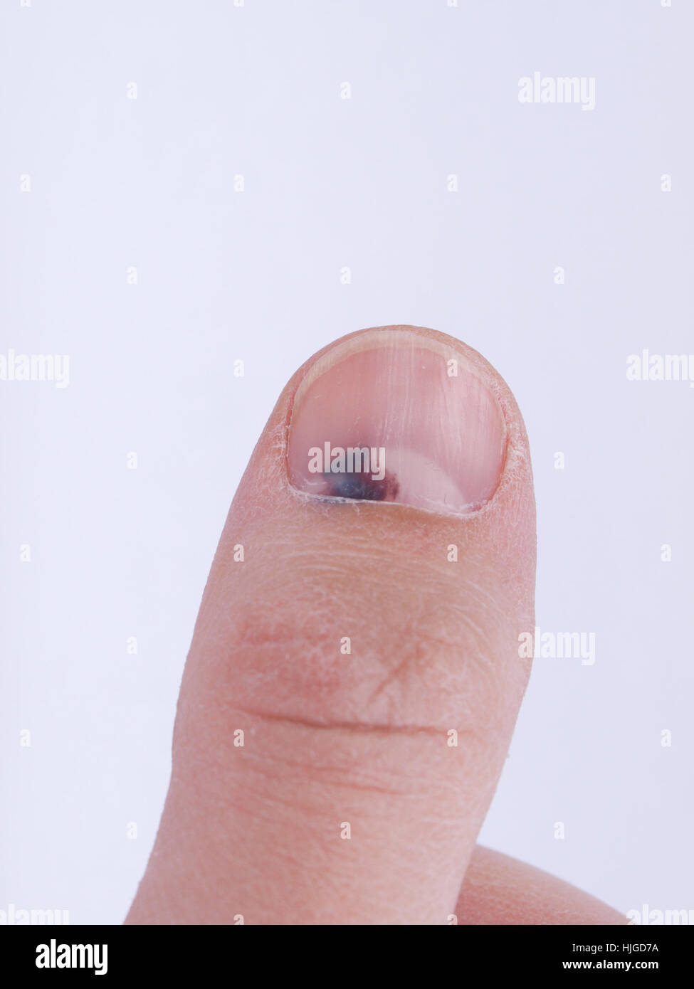 Subungual hematoma collection of blood underneath fingernail (black