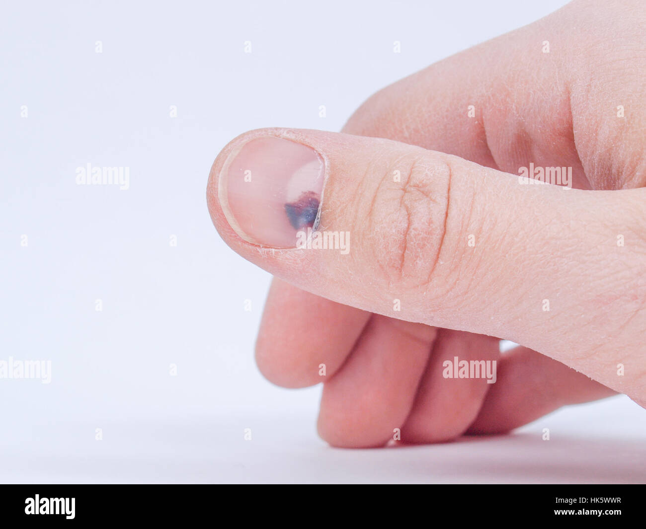 Subungual hematoma hi-res stock photography and images - Alamy