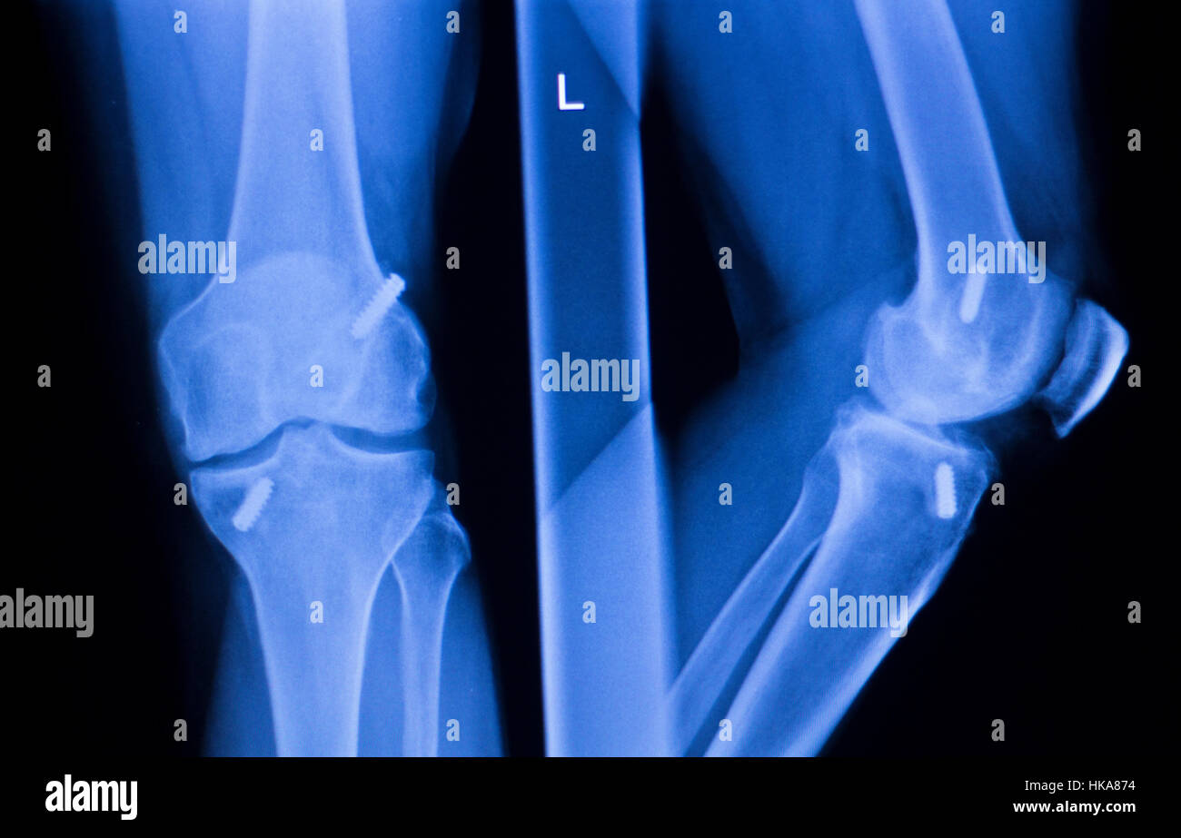 Tibia metal plate hi-res stock photography and images - Alamy